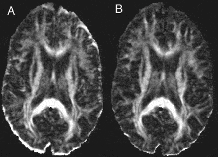 Diffusion Tensor Imaging. Diffusion Tensor Imaging