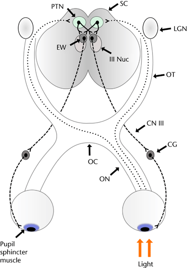 Amaurotic Pupil