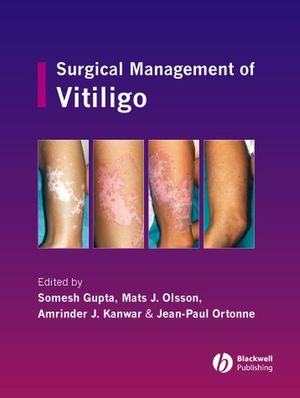 Surgical Management of Vitiligo (1405145218) cover image