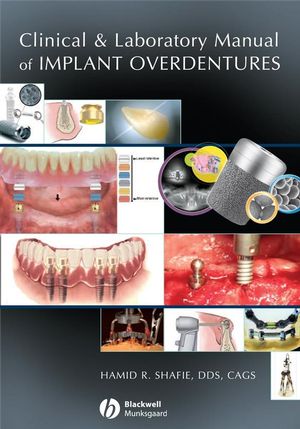 Clinical and Laboratory Manual of Implant Overdentures (1118696921) cover image