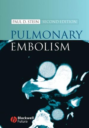 Pulmonary Embolism, 2nd Edition (0470691328) cover image
