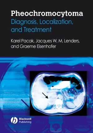 Pheochromocytoma Diagnosis Localization And Treatment Wiley