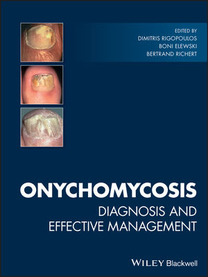 Diagnosis and Management of Onychomycosis (Tinea Unguium) with