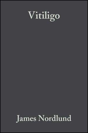 Vitiligo: A Monograph on the Basic and Clinical Science
